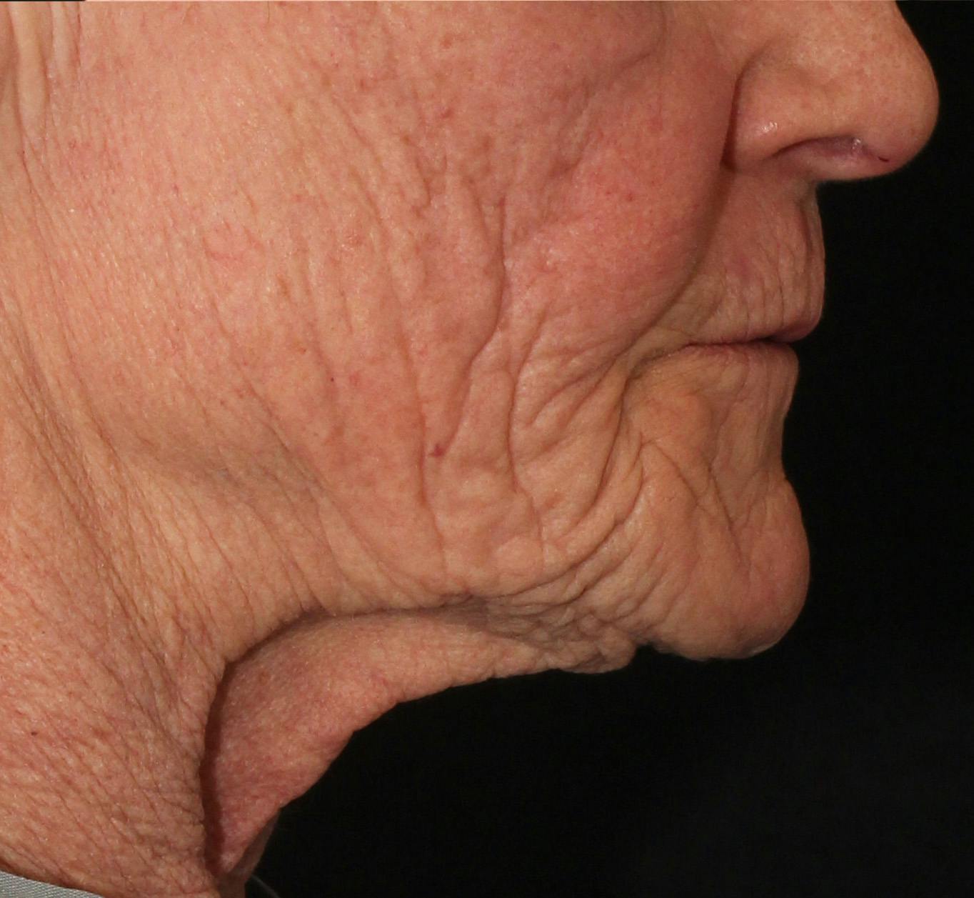 Before & After Ellacor®