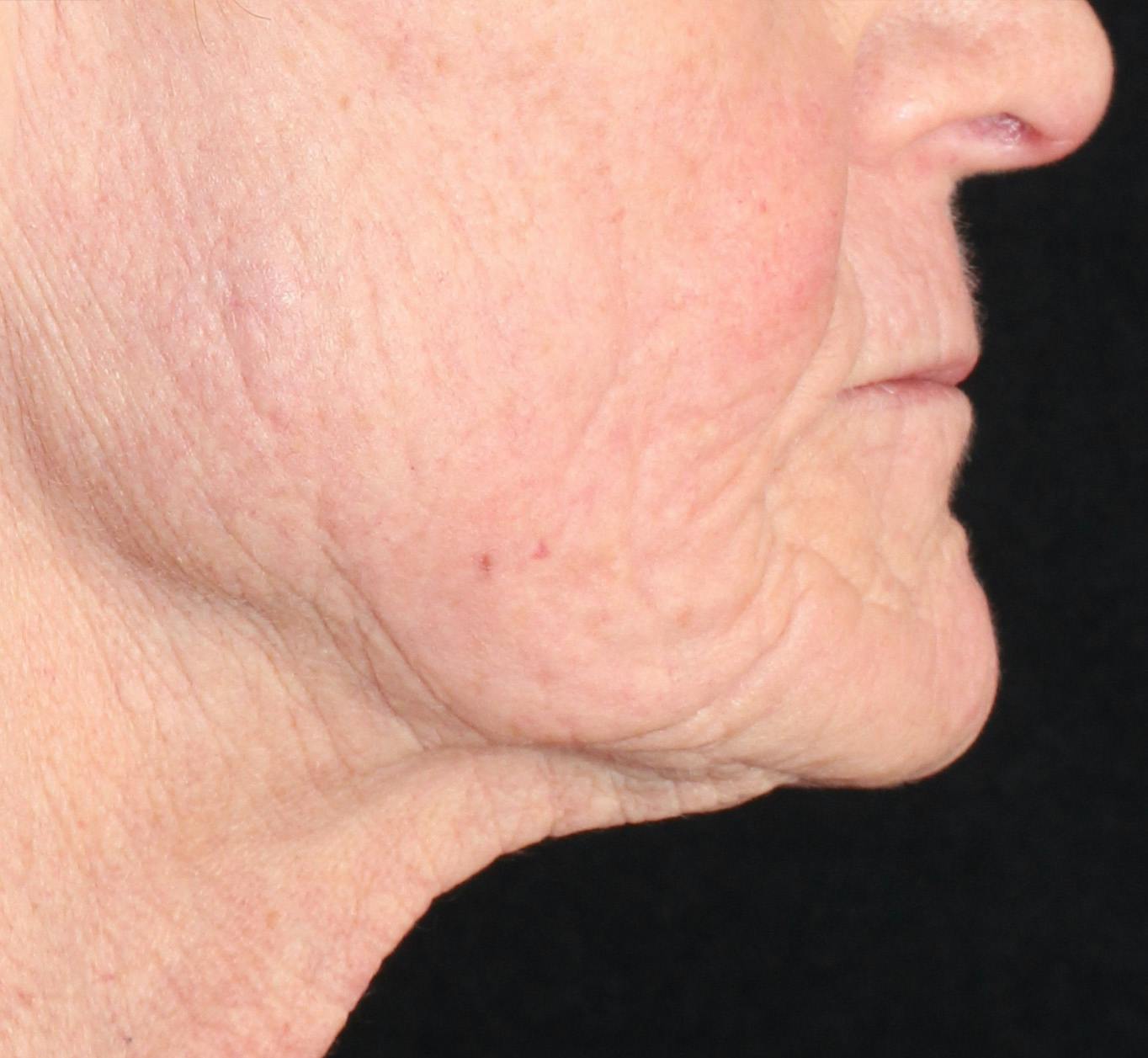 Before & After Ellacor®