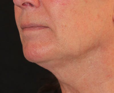 Ellacor Before & After Gallery - Patient 139161 - Image 1