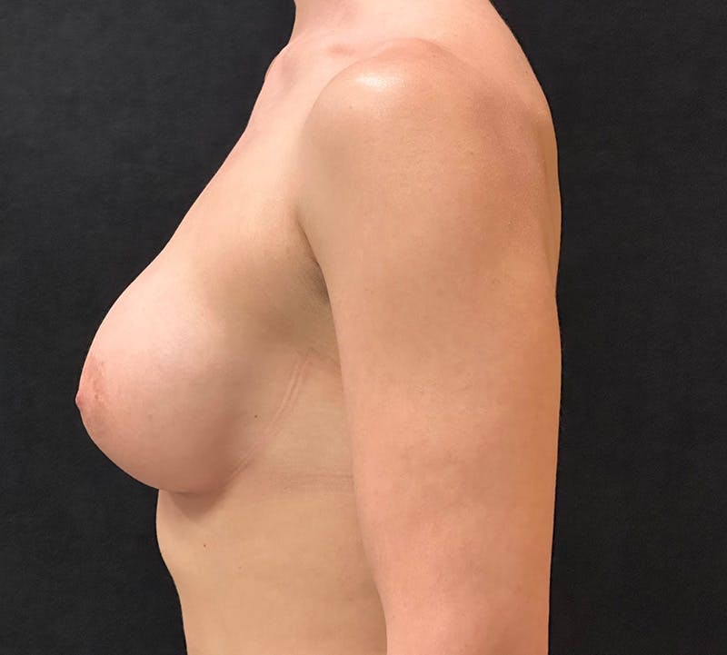 Breast Augmentation Subfascial Before & After Gallery - Patient 339768 - Image 10