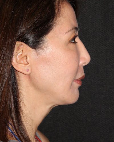 Facetite Before & After Gallery - Patient 106387062 - Image 2