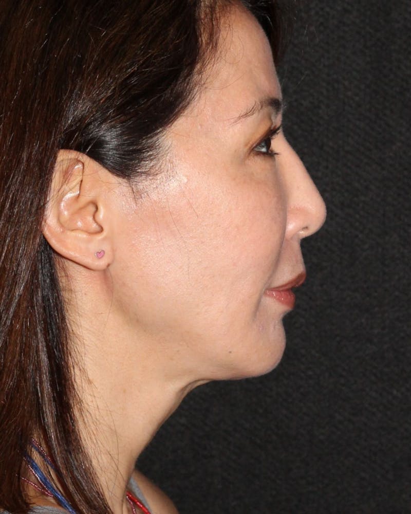Facetite Before & After Gallery - Patient 106387062 - Image 2