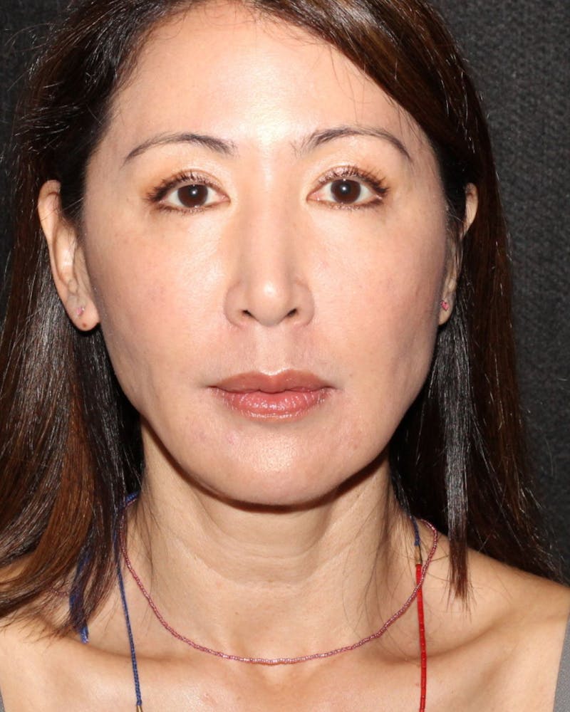 Facetite Before & After Gallery - Patient 106387062 - Image 6
