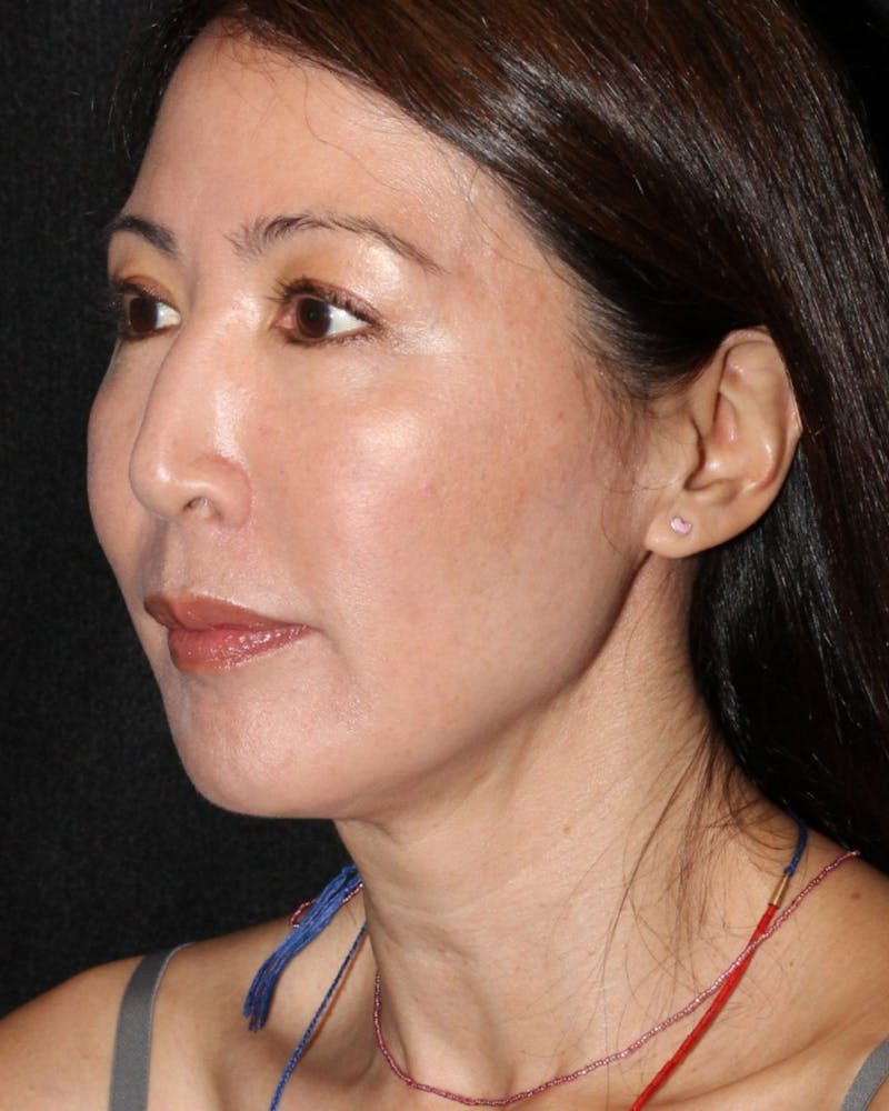 Facetite Before & After Gallery - Patient 106387062 - Image 8
