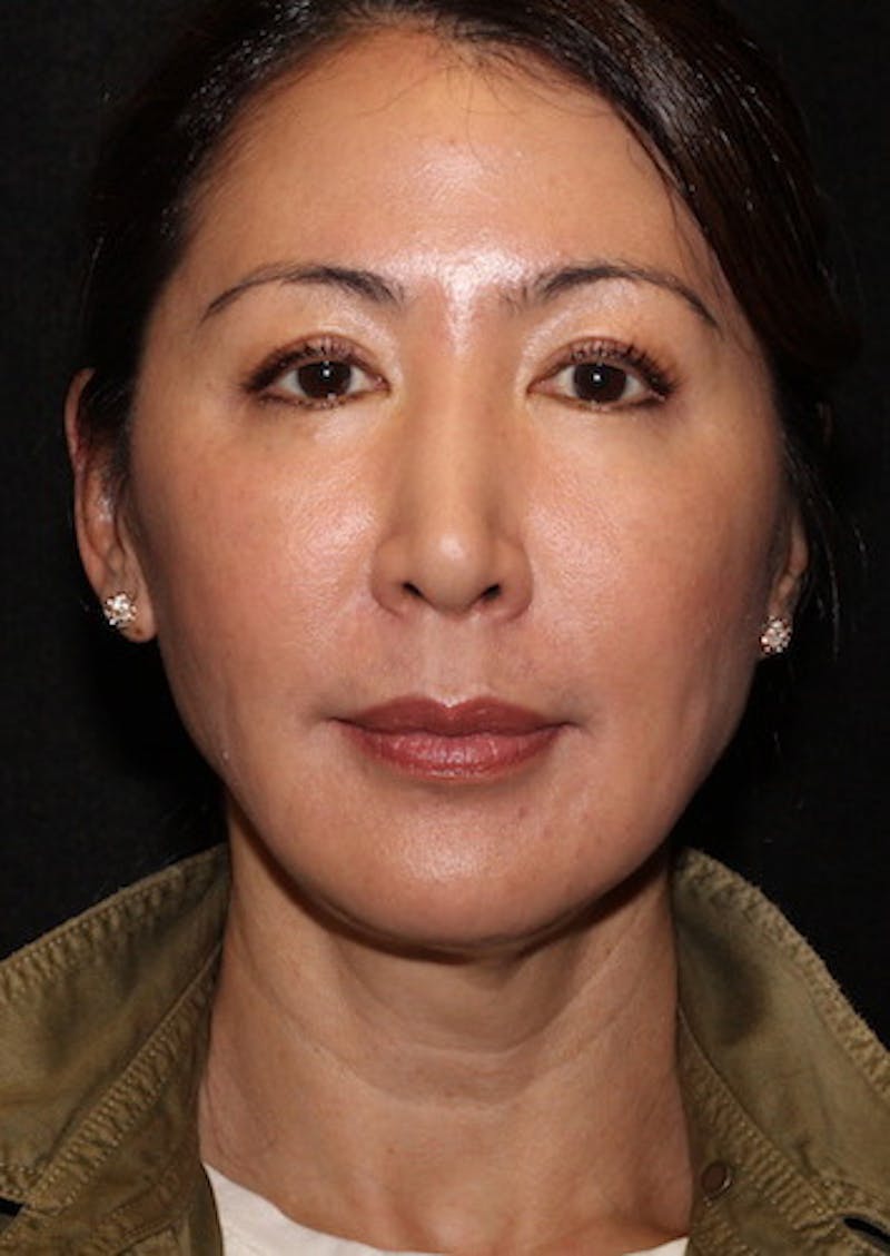 Facetite Before & After Gallery - Patient 106387062 - Image 5