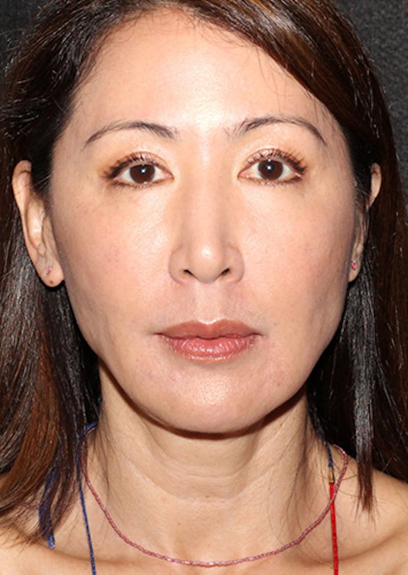 Facetite Before & After Gallery - Patient 106387062 - Image 6