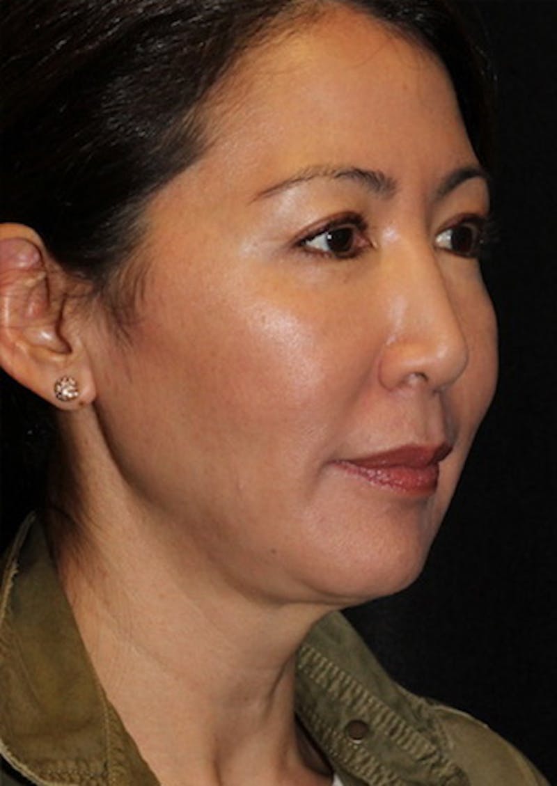 Facetite Before & After Gallery - Patient 106387062 - Image 3