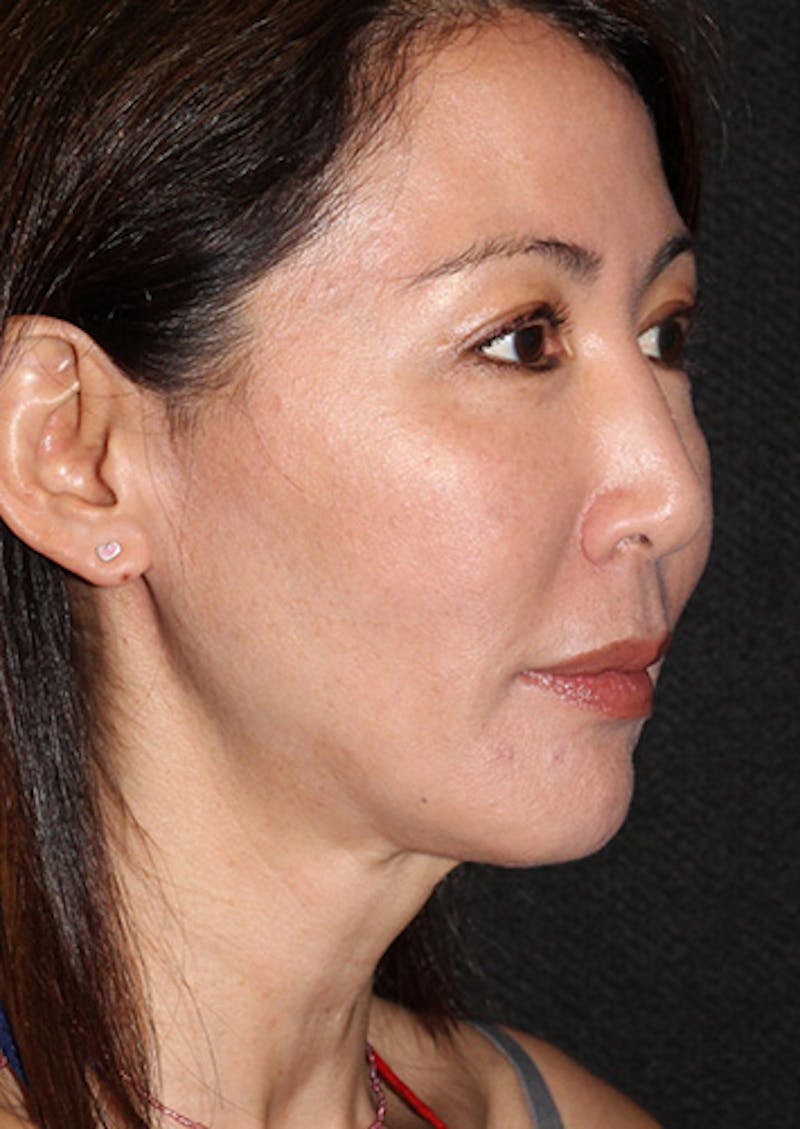 Facetite Before & After Gallery - Patient 106387062 - Image 4