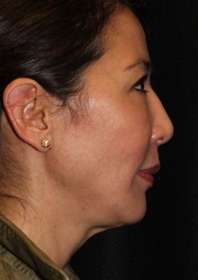 Facetite Before & After Gallery - Patient 106387062 - Image 1