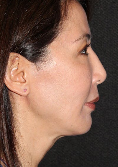 Facetite Before & After Gallery - Patient 106387062 - Image 2