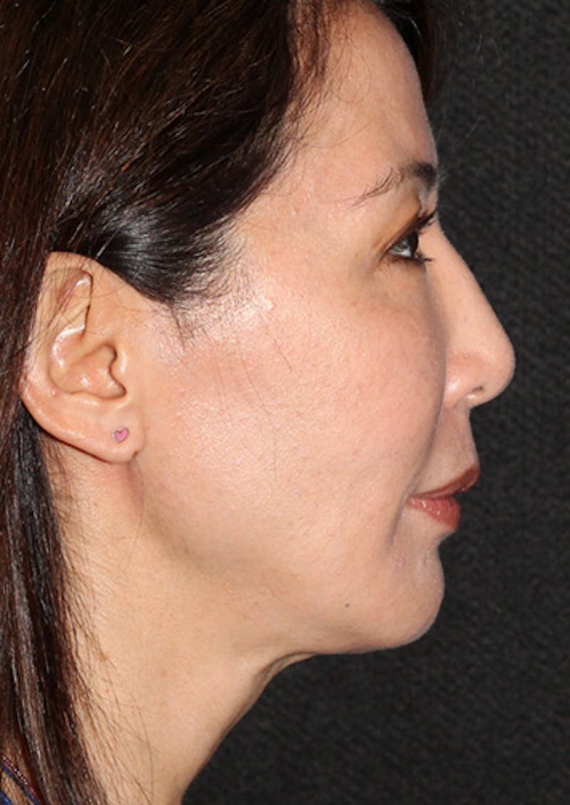 Facetite Before & After Gallery - Patient 106387062 - Image 2