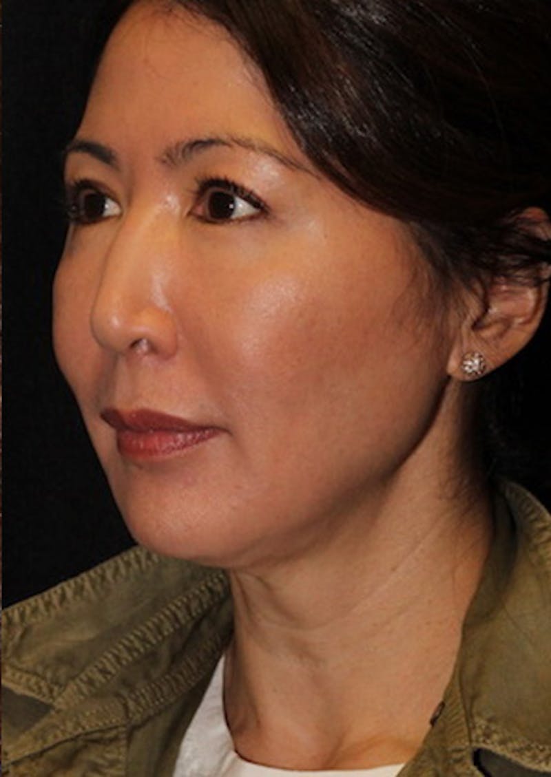 Facetite Before & After Gallery - Patient 106387062 - Image 7