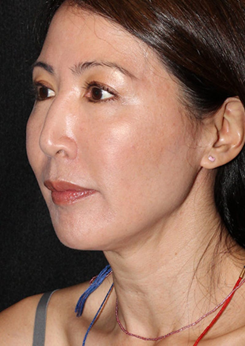 Facetite Before & After Gallery - Patient 106387062 - Image 8