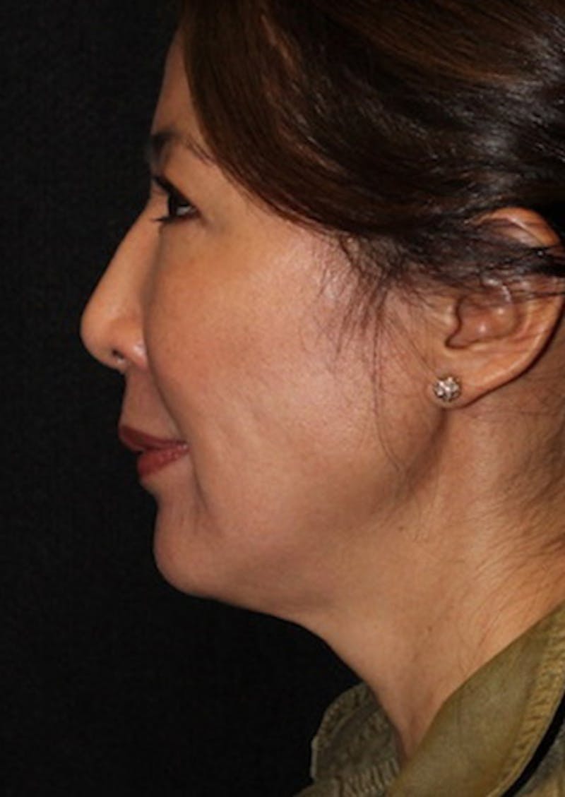 Facetite Before & After Gallery - Patient 106387062 - Image 9