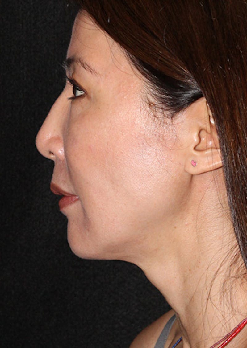 Facetite Before & After Gallery - Patient 106387062 - Image 10