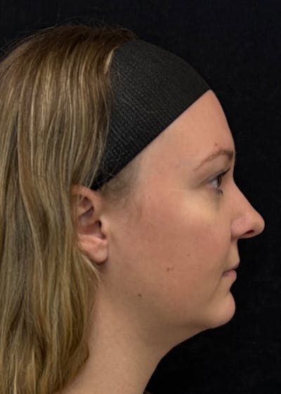 Facetite Before & After Gallery - Patient 649487 - Image 1