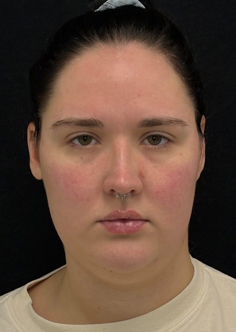 Facetite Before & After Gallery - Patient 284406 - Image 5