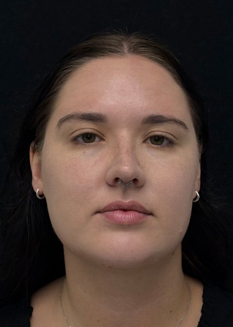 Facetite Before & After Gallery - Patient 284406 - Image 6