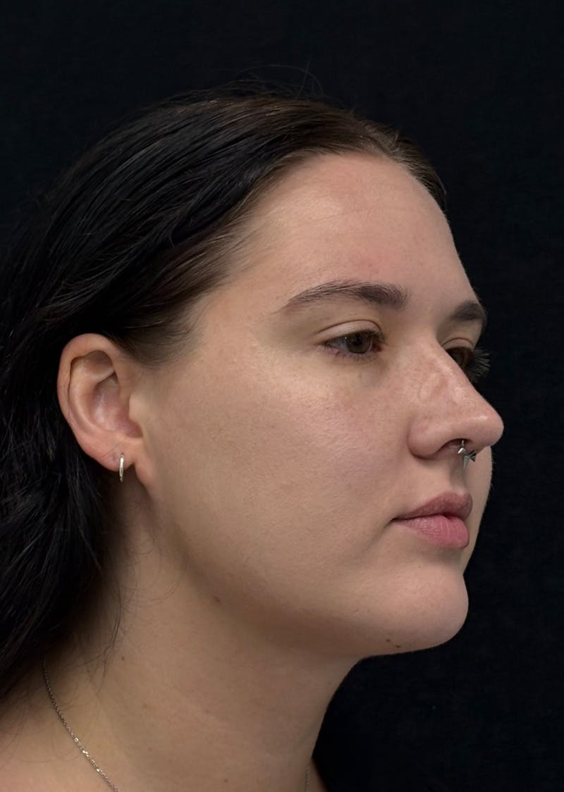 Facetite Before & After Gallery - Patient 284406 - Image 4