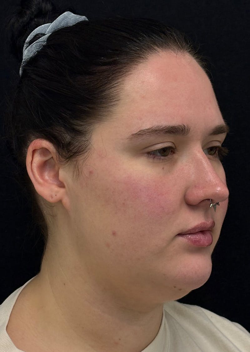 Facetite Before & After Gallery - Patient 284406 - Image 3