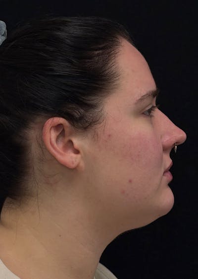 Facetite Before & After Gallery - Patient 284406 - Image 1
