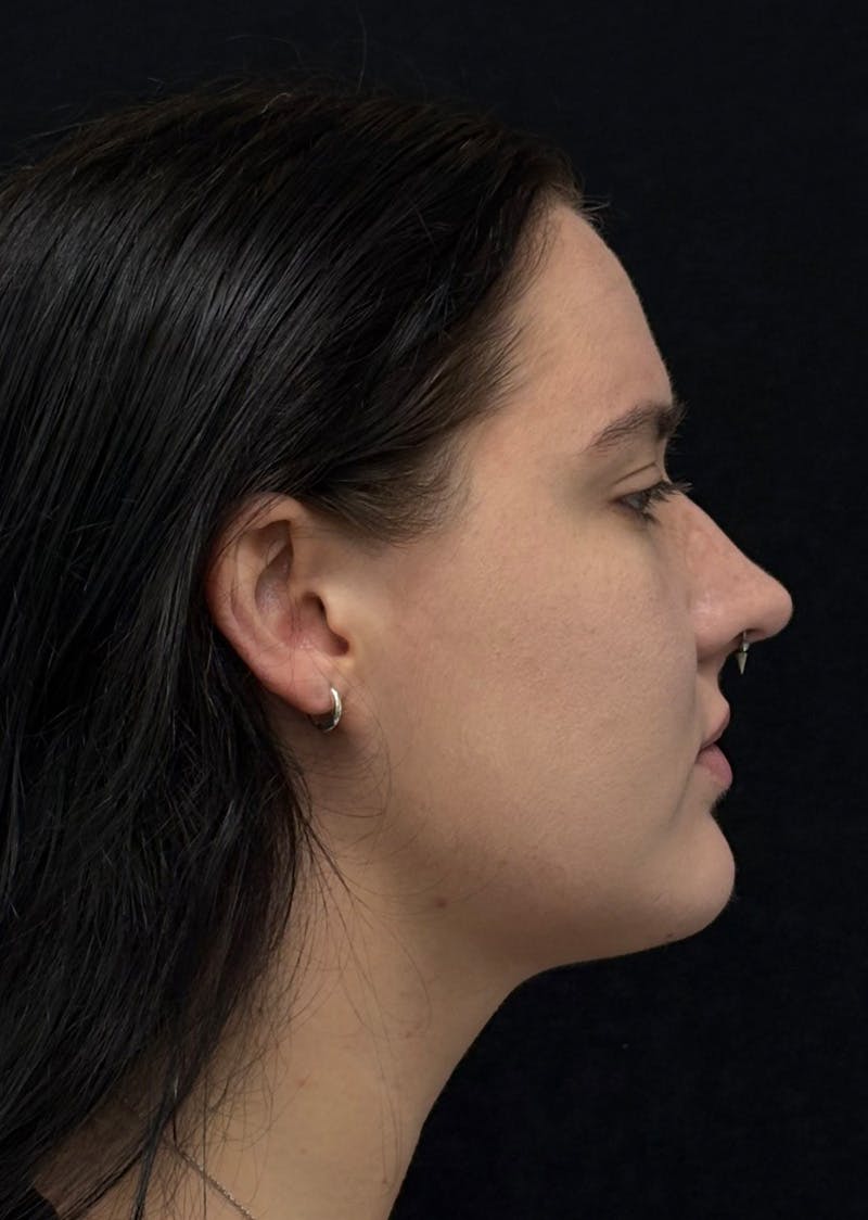Facetite Before & After Gallery - Patient 284406 - Image 2