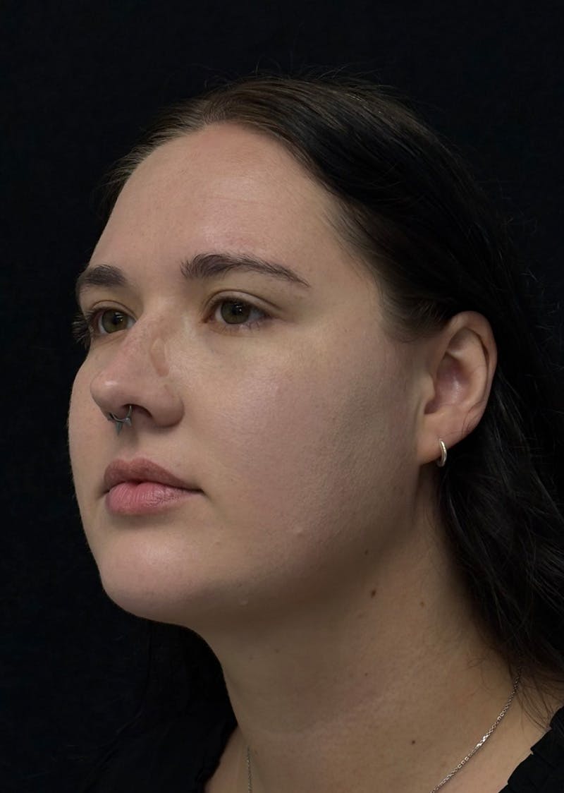 Facetite Before & After Gallery - Patient 284406 - Image 8