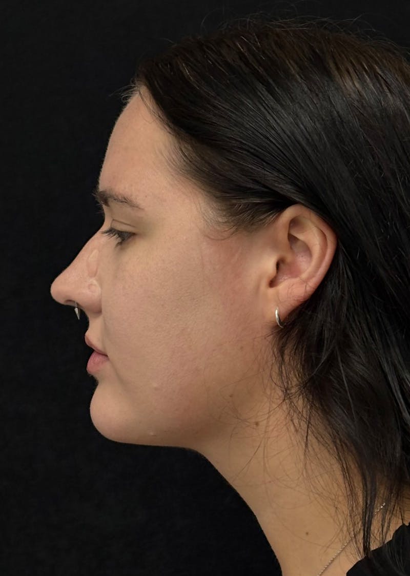 Facetite Before & After Gallery - Patient 284406 - Image 10