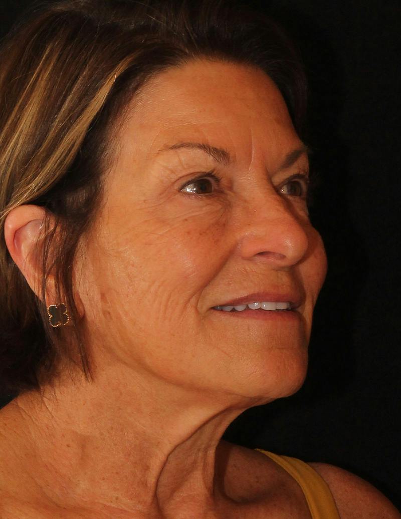 Facelift/Neck Lift Before & After Gallery - Patient 158286 - Image 4