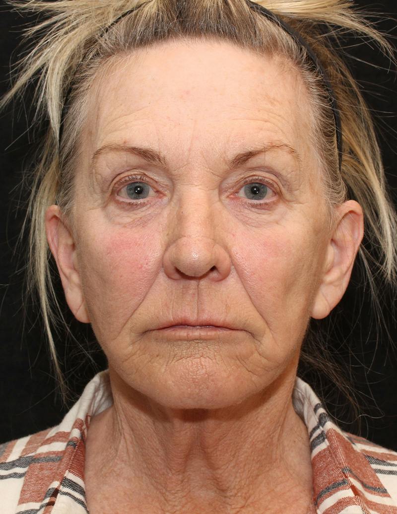 Facelift/Neck Lift Before & After Gallery - Patient 277135 - Image 6