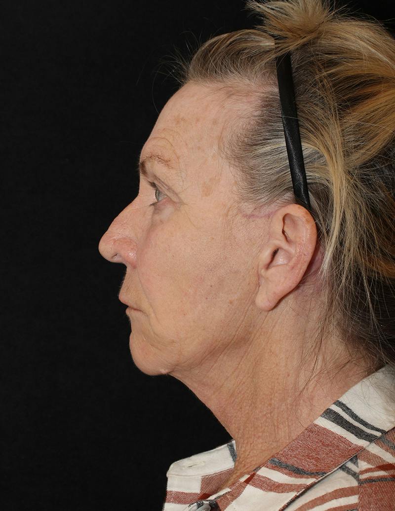 Facelift/Neck Lift Before & After Gallery - Patient 277135 - Image 10