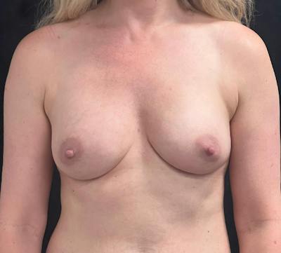 Preservé Breast Augmentation Before & After Gallery - Patient 107052 - Image 2