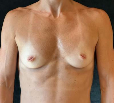 Preservé Breast Augmentation Before & After Gallery - Patient 211471 - Image 1