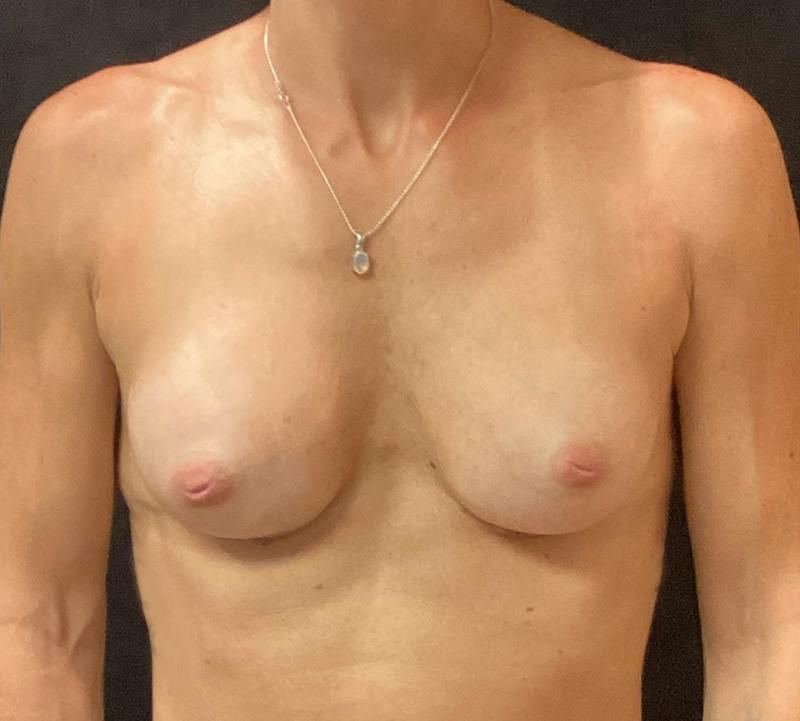 Preservé Breast Augmentation Before & After Gallery - Patient 211471 - Image 2