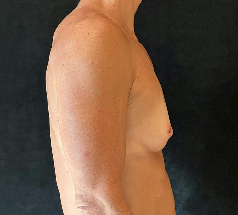 Preservé Breast Augmentation Before & After Gallery - Patient 211471 - Image 5