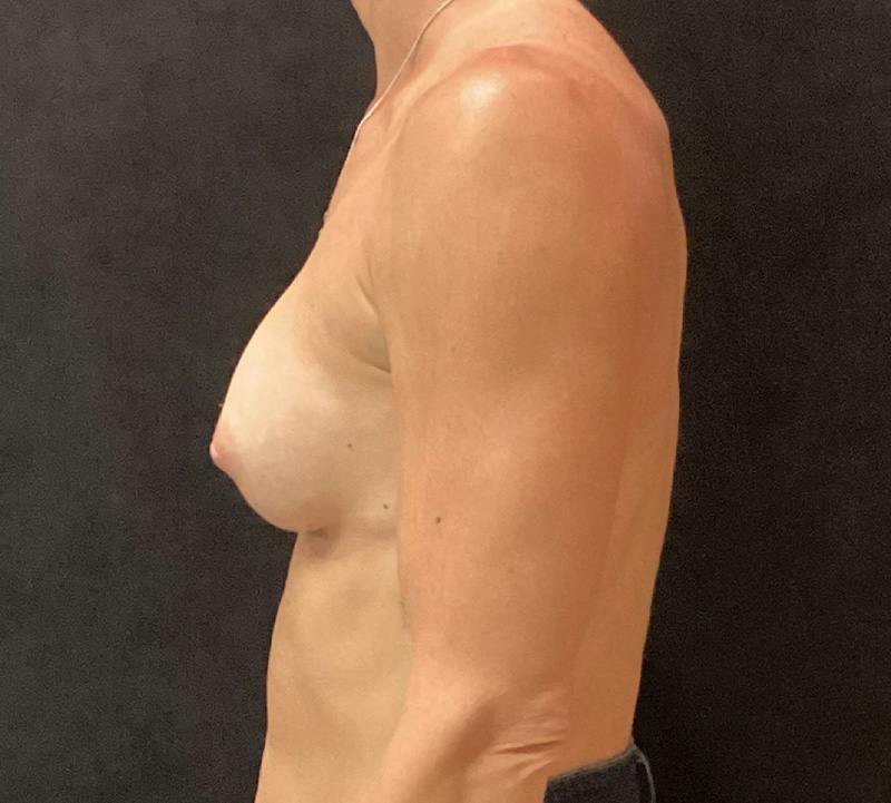 Preservé Breast Augmentation Before & After Gallery - Patient 211471 - Image 10