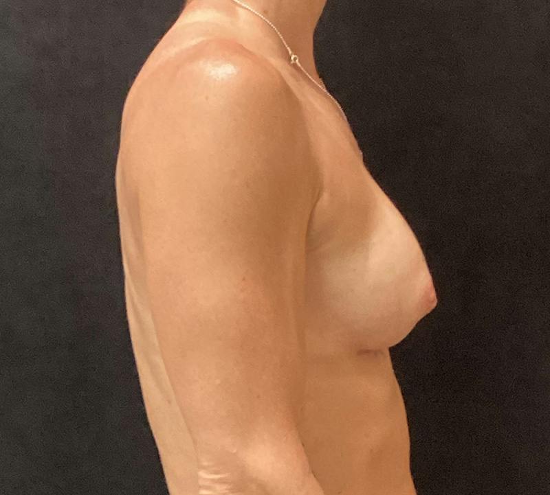 Preservé Breast Augmentation Before & After Gallery - Patient 211471 - Image 6
