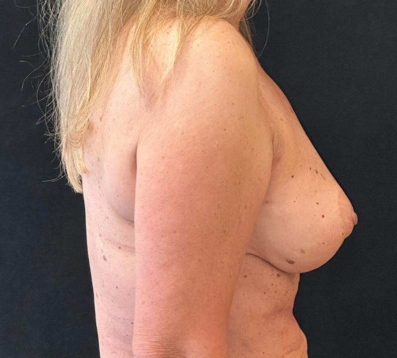 Fat Grafting Before & After Gallery - Patient 596434 - Image 6