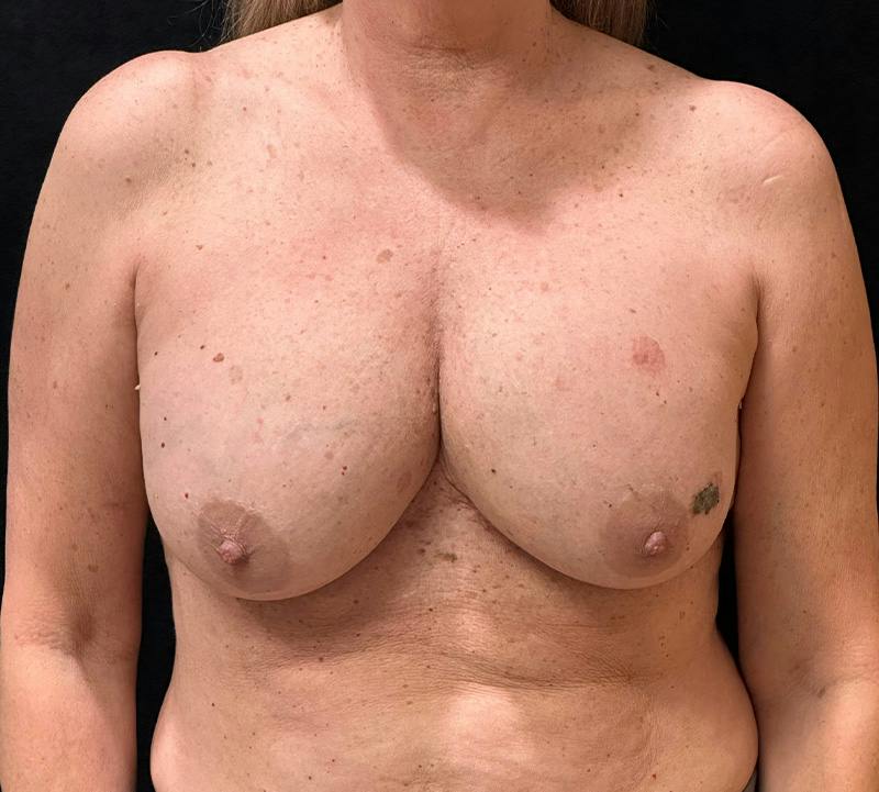Fat Grafting Before & After Gallery - Patient 596434 - Image 1