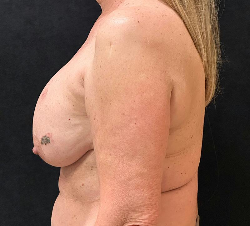 Fat Grafting Before & After Gallery - Patient 596434 - Image 9