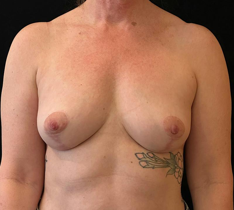 Fat Grafting Before & After Gallery - Patient 424422 - Image 2