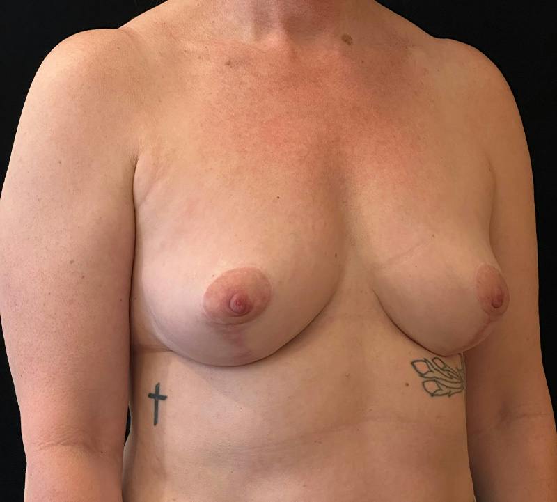 Fat Grafting Before & After Gallery - Patient 424422 - Image 4