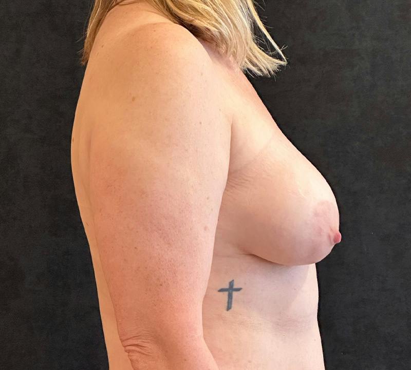 Fat Grafting Before & After Gallery - Patient 424422 - Image 5