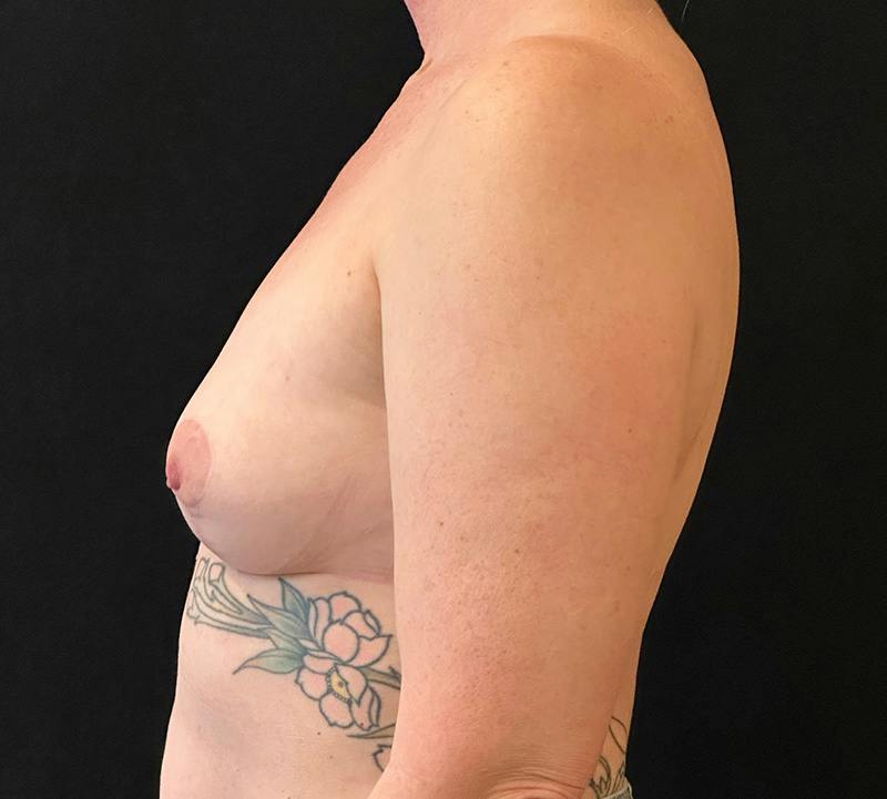 Fat Grafting Before & After Gallery - Patient 424422 - Image 10