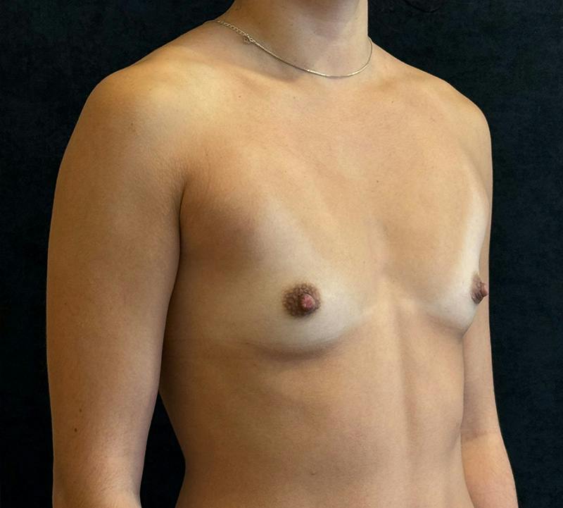 Breast Augmentation Subfascial Before & After Gallery - Patient 256335 - Image 3