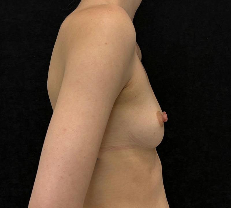 Breast Augmentation Subfascial Before & After Gallery - Patient 127263 - Image 5