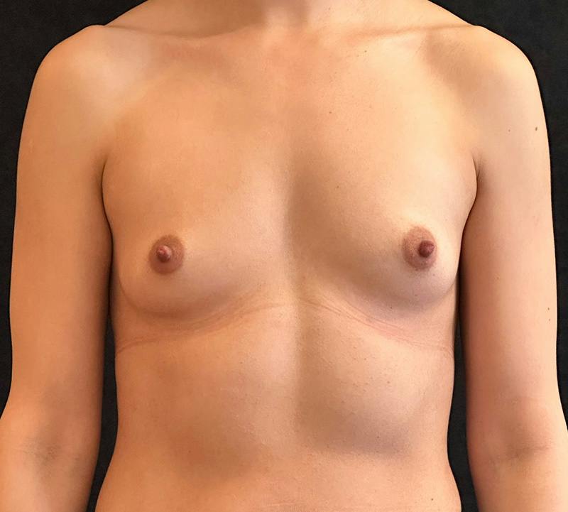 Breast Augmentation Subfascial Before & After Gallery - Patient 123674 - Image 1