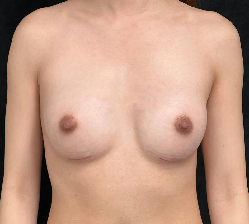Breast Augmentation Subfascial Before & After Gallery - Patient 230829 - Image 2