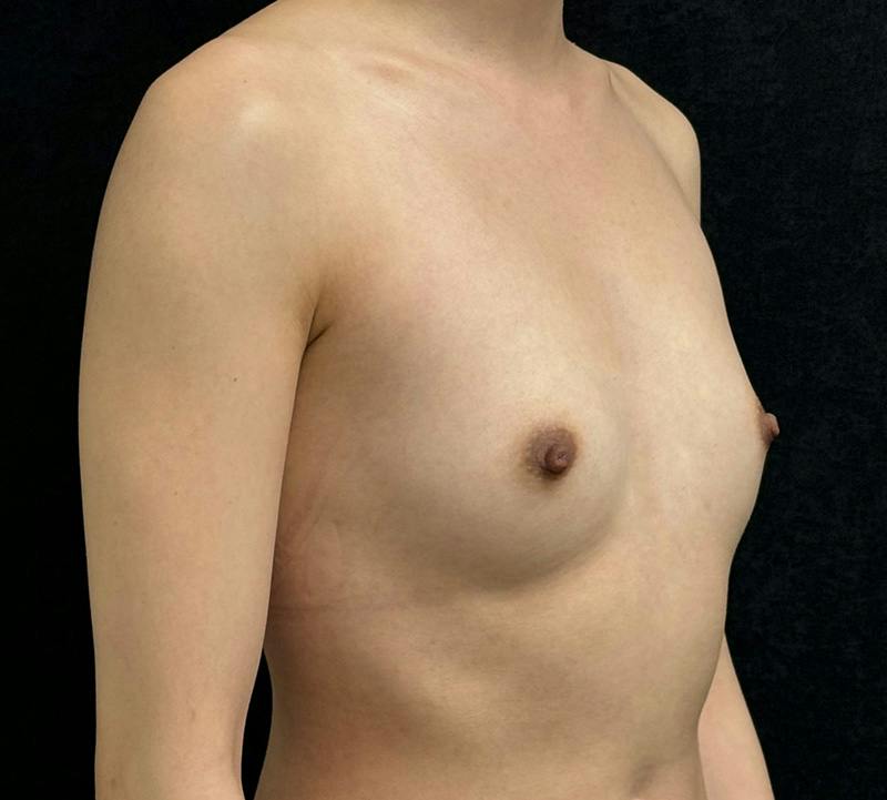 Breast Augmentation Subfascial Before & After Gallery - Patient 230829 - Image 3