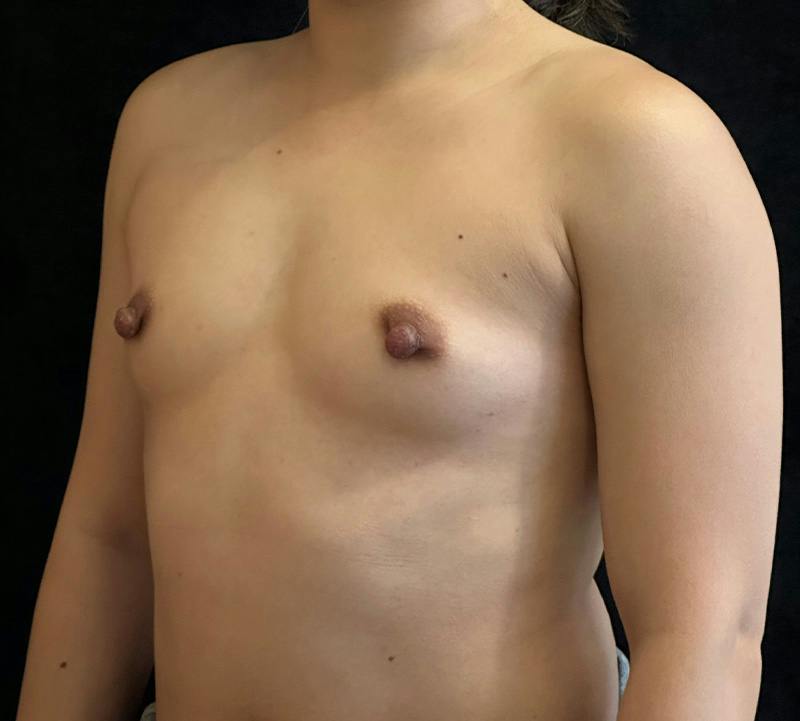 Breast Augmentation Subfascial Before & After Gallery - Patient 331881 - Image 7